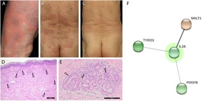 Case report: Schnitzler-like syndrome without monoclonal gammopathy